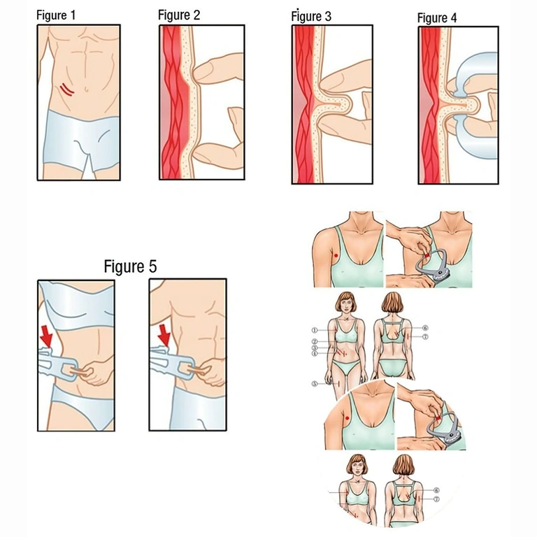 Jak używać kalipera do pomiaru fałdów skóry